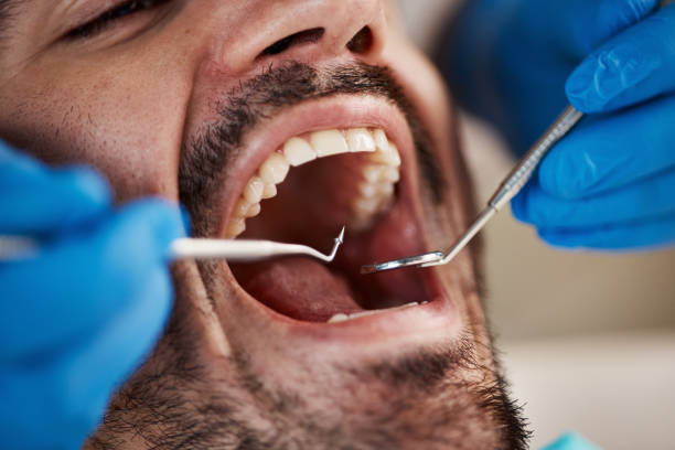 Best Emergency Dentist for Knocked-Out Tooth in Brady, TX