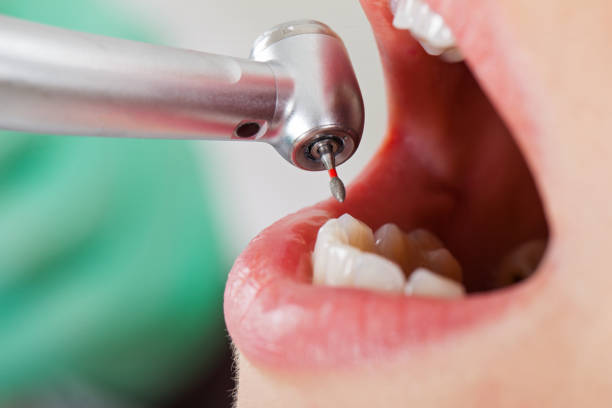 Best Emergency Dental Extractions in Brady, TX